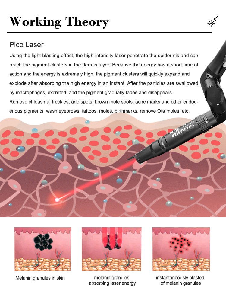 non-invasive laser for mole removal