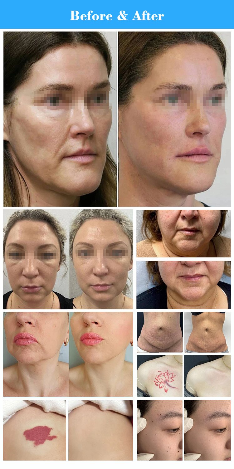 high energy picosecond laser for tattoo removal
