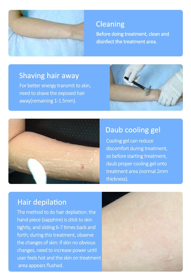 Professional 808nm Diode Laser Hair Removal Machine - Image 15